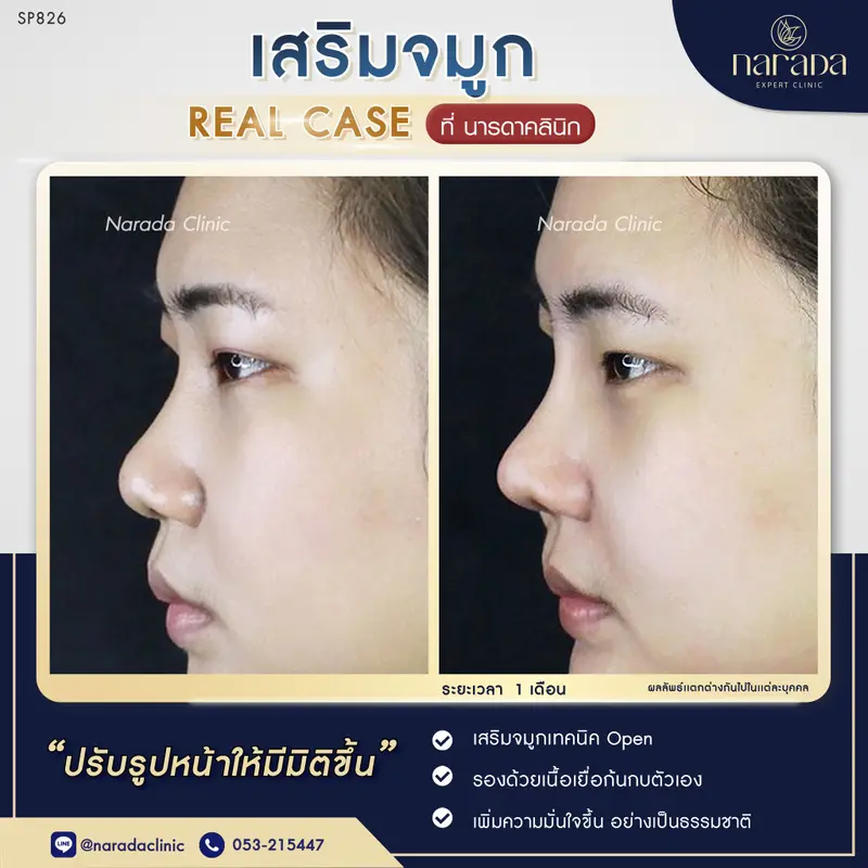  เสริมจมูกเทคนิค Open+รองเนื้อเยื่อก้นกบตัวเอง ที่ นารดาคลินิก