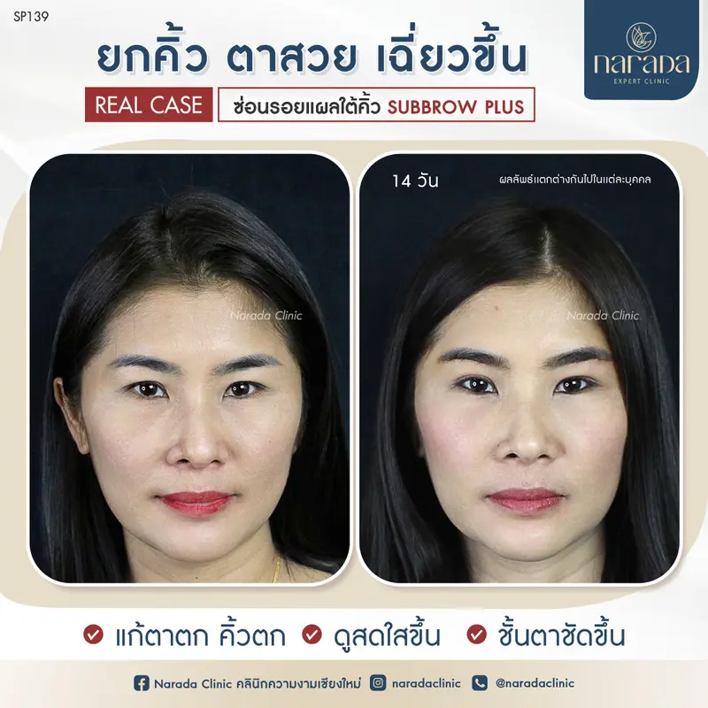ยกคิ้ว ดวงตาสวย เฉี่ยวขึ้นอย่างเป็นธรรมชาติ ด้วย SUB BROW PLUS ที่ นารดาคลินิก
