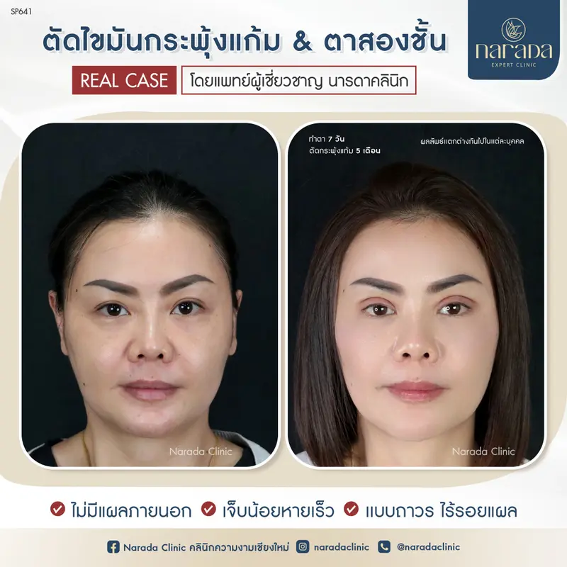 หน้าเล็กลง ดูมีเสน่ห์อย่างเป็นธรรมชาติ  ตัดไขมันกระพุ้งแก้ม & ตาสองชั้น ที่ นารดาคลินิก