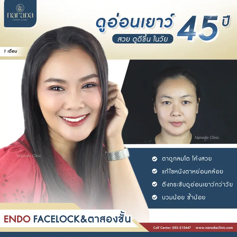 ดูอ่อนเยาว์ สวย ดูดีขึ้นในวัย 45 ปี  ENDO-FACELOCK & ตาสองชั้นเทคนิดกรีดยาว