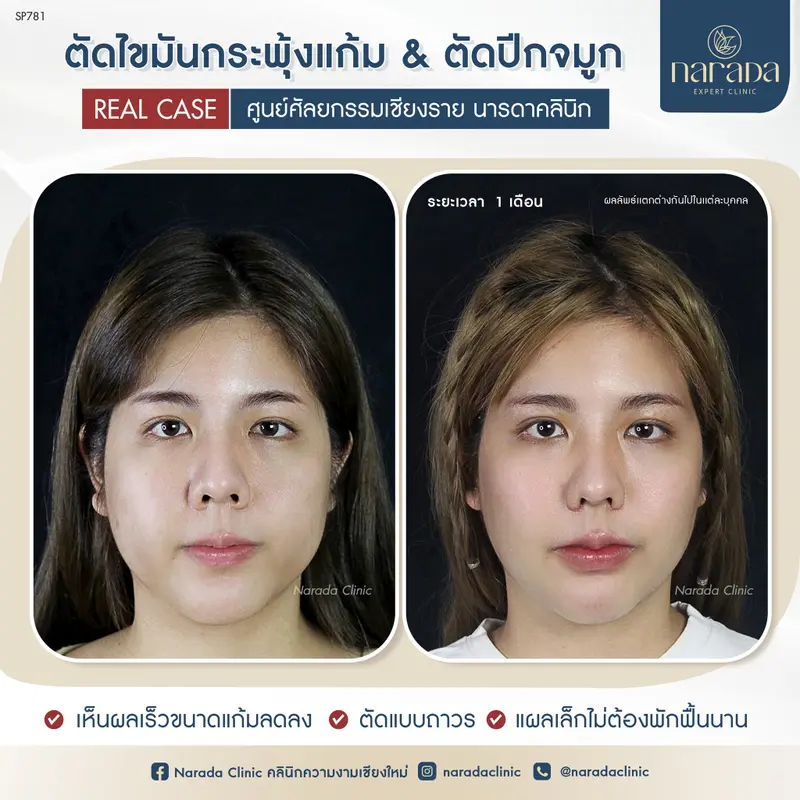 ลดแก้มป่อง แก้มย้อย ปรับรูปหน้าให้เล็กลง  ตัดไขมันกระพุ้งแก้ม&ตัดปีกจมูก ที่ นารดาคลินิก
