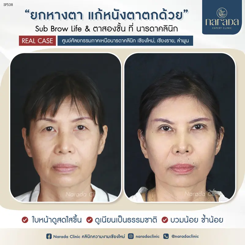 ยกหางตา แก้หนังตาตก  ด้วย SUB BROW PLUS & ตาสองชั้น ที่ นารดาคลินิก