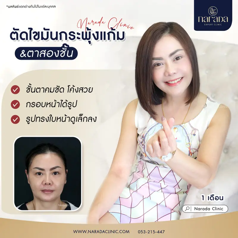 ทำให้หน้าเรียว กระชับแบบถาวร  ที่ นารดาคลินิก ตัดไขมันกระพุ้งแก้ม&ตาสองชั้นเทคนิคกรีดยาว