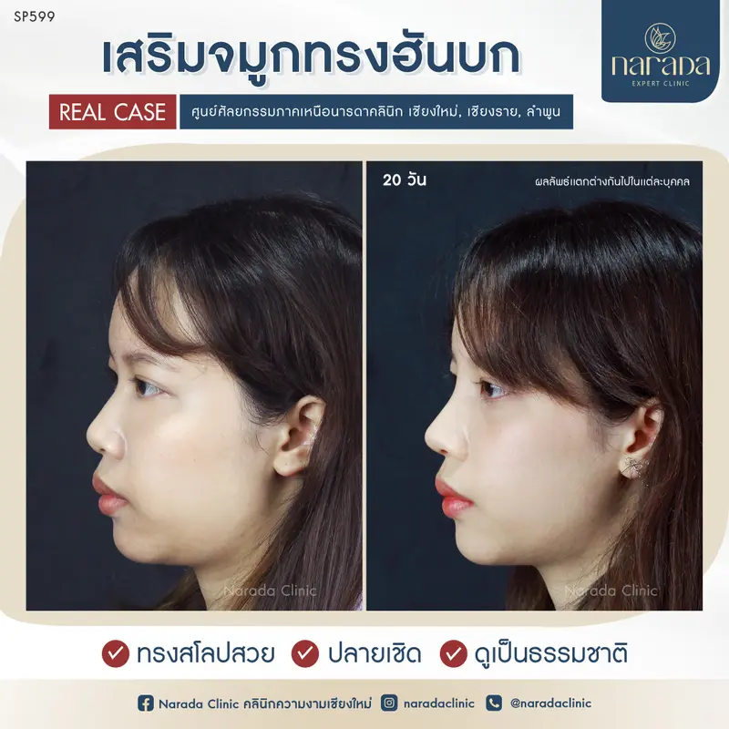 เสริมจมูกทรงสวย อย่างเป็นธรรมชาติ ทรงฮันบกเทคนิค Semi-Open ที่ นารดาคลินิก
