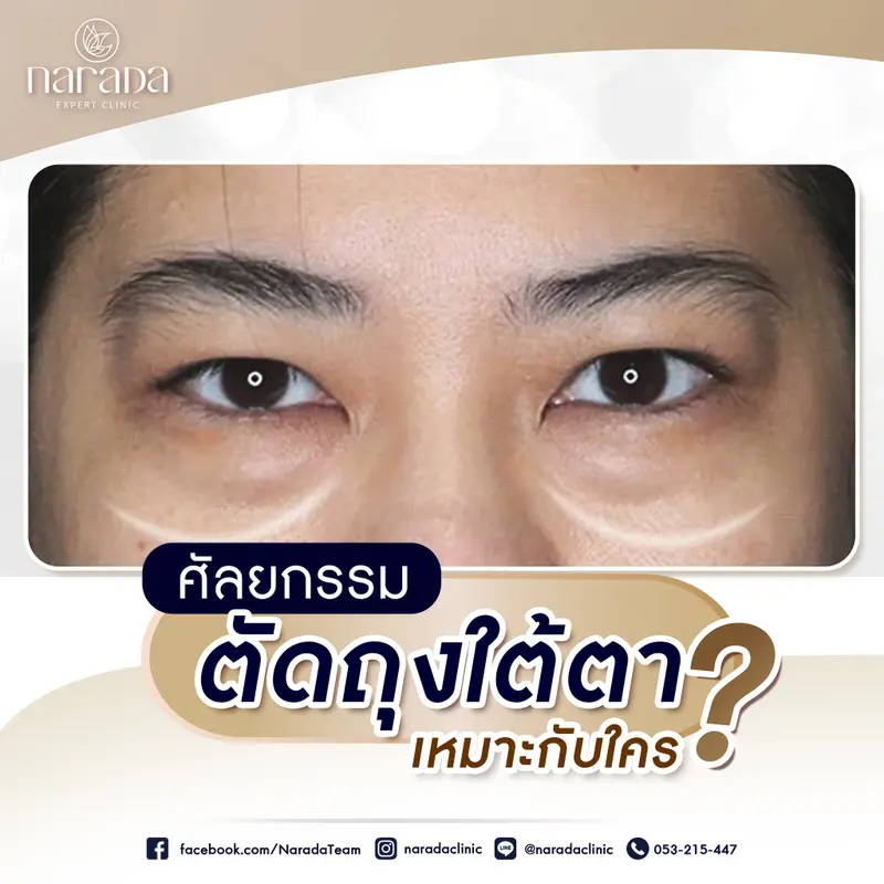 จัดเรียงถุงใต้ตาใหม่ ด้วยการตัดถุงใต้ตา  เพิ่มความมั่นใจ ที่ นารดาคลินิก