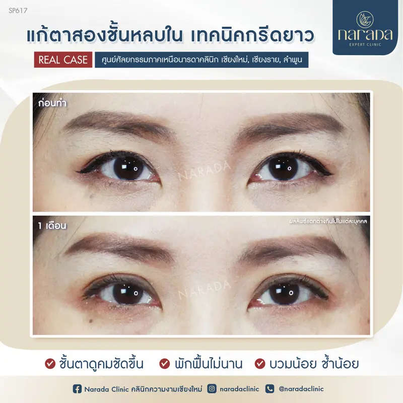 แก้ตาสองชั้นหลบใน ดูดีอย่างเป็นธรรมชาติ ตาสองชั้นเทคนิคกรีดยาว นารดาคลินิก