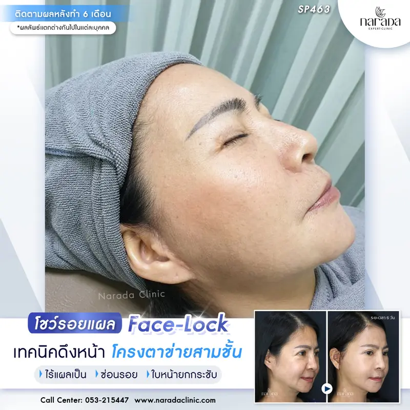  ย้อนวัยหน้า อย่างเป็นธรรมชาติ ด้วยเทคนิคดึงหน้า ที่นารดาคลินิก