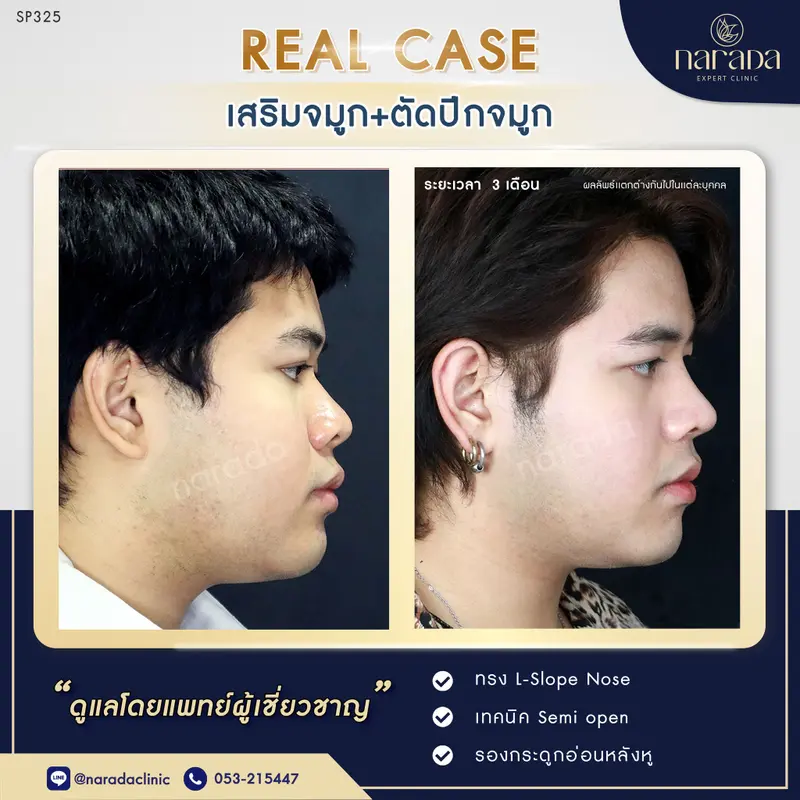 ทรงจมูกเดิมที่ไม่เข้ากับรูปหน้าไม่ได้มิติ ได้ทรงใหม่ที่ประทับใจและปลอดภัย