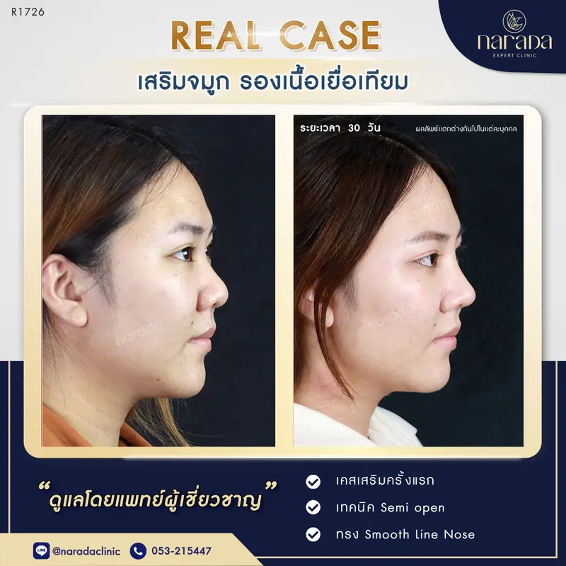 โด่งแบบปลอดภัย ที่ นารดาคลินิก