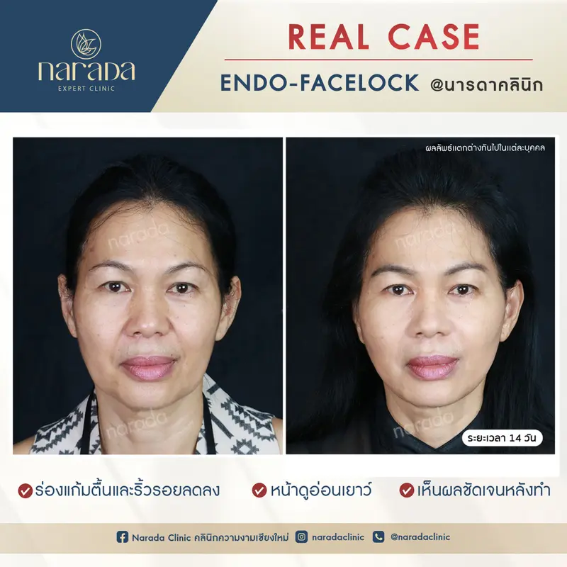 การผ่าตัดดึงหน้าช่วยลดปัญหาการหย่อนคล้อยและริ้วรอยบนใบหน้าให้กลับมาเป็นสาวอีกครั้ง