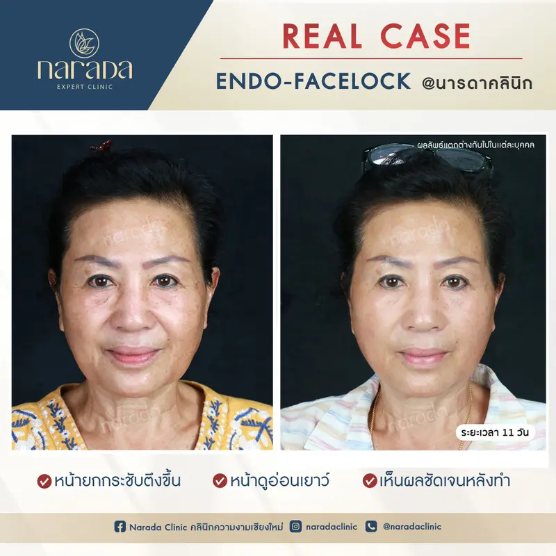 ใบหน้าดูเต่งตึง ดูอ่อนวัย โดยวิธีการผ่าตัดยกกระชับใบหน้าเพื่อลดริ้วรอยแห่งวัย