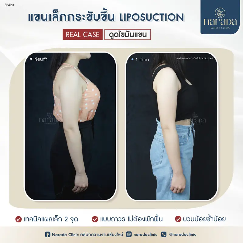 แขนเล็กกระชับ อย่างมั่นใจ ที่ นารดาคลินิก