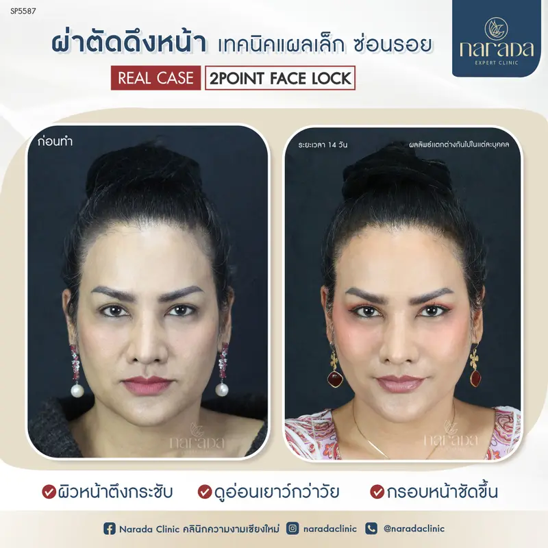 ดึงหน้าลดอายุ ที่ นารดาคลินิก