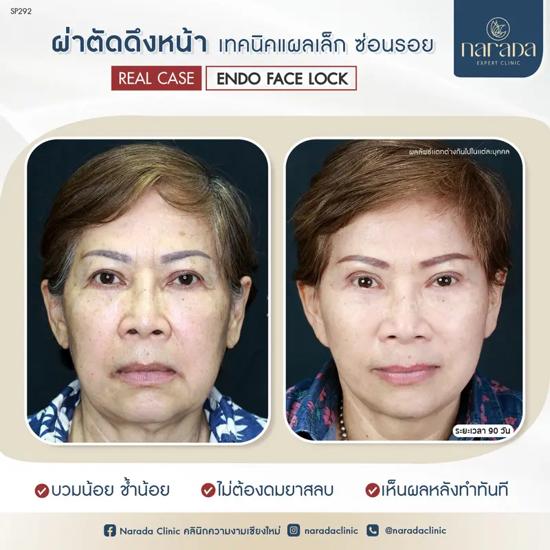 ปรับหน้าดึง ลดอายุ ที่ นารดาคลินิก