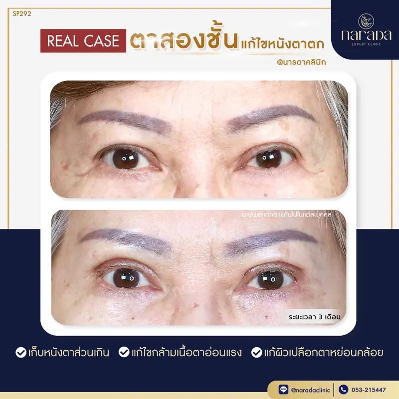 หนังตาตก พบได้ในคนที่มีอายุมากขึ้น หรือคนที่มีตาช้้นเดียวก็จะทำให้หนังตาตกเร็วขึ้น