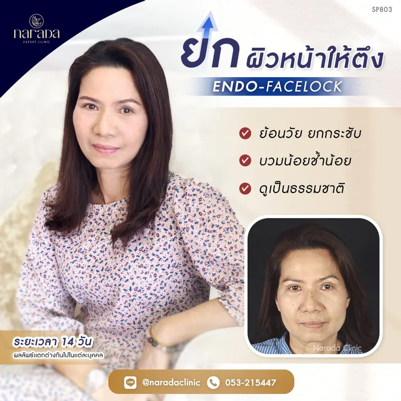ดูอ่อนเยาว์กว่าวัย ยกผิวหน้าให้ตึงกกระชับ ด้วย ENDO-FACELOCK  นารดาคลินิก