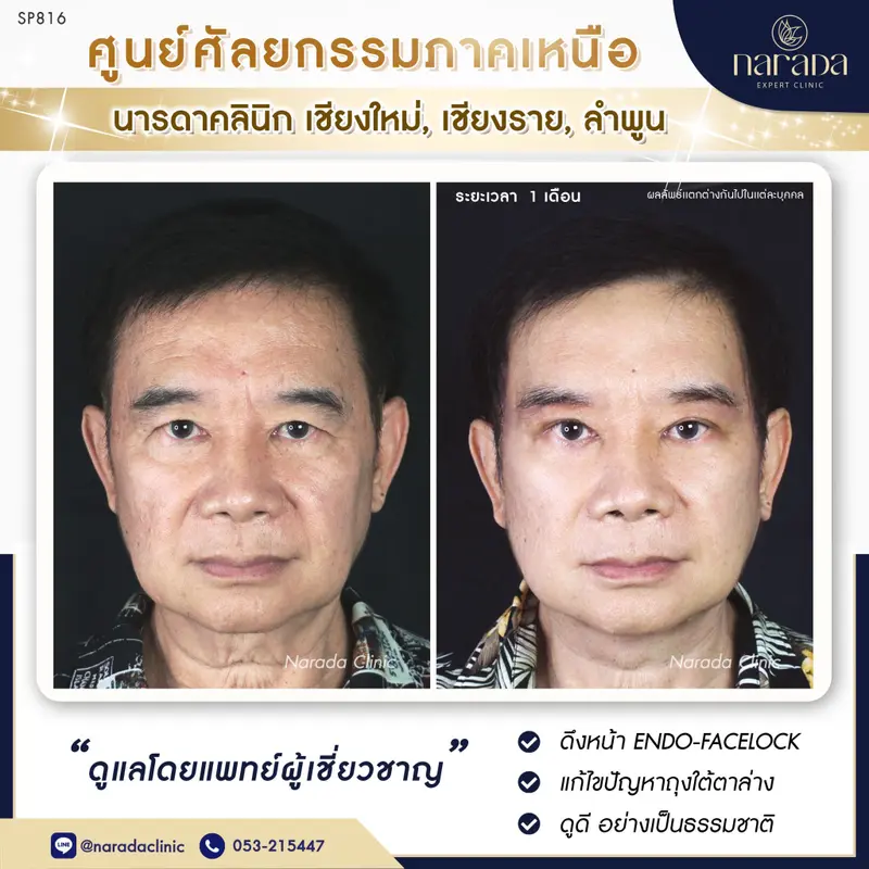 ยกให้ใช่ ดูอ่อนเยาว์กว่าวัย แก้ไขอย่างตรงจุด  ENDO-FACE LOCK ที่ นารดาคลินิก