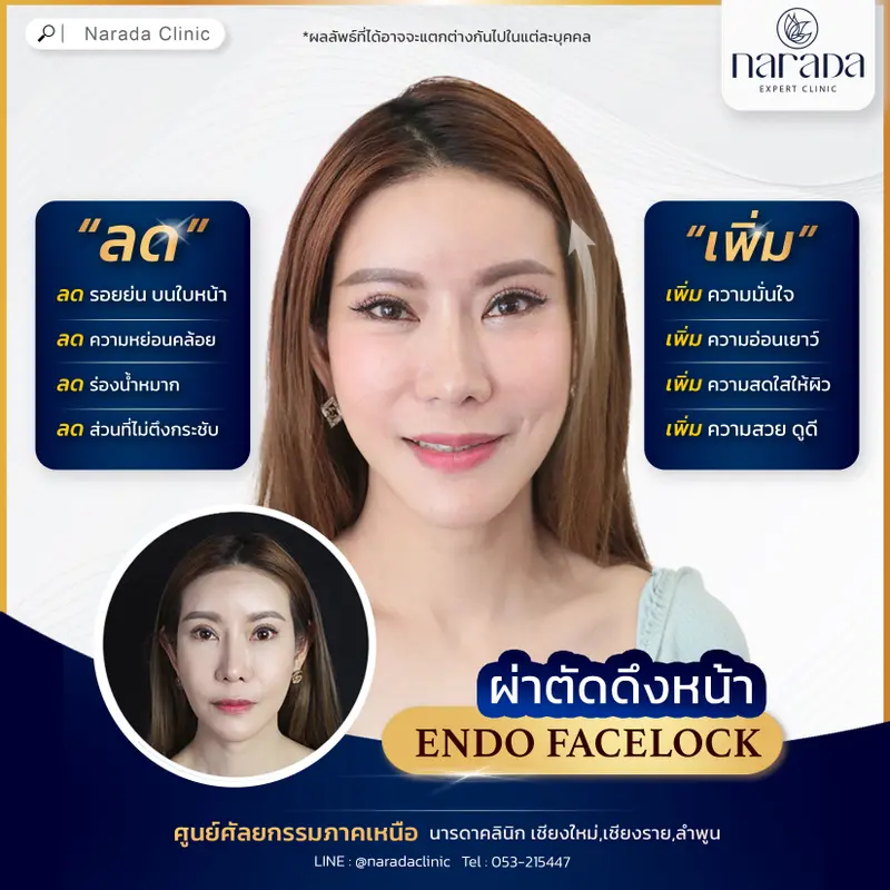 ลดปัญหาอย่างตรงจุด เพิ่มอย่างมั่นใจด้วย ENDO FACELOCK ที่ นารดาคลินิก