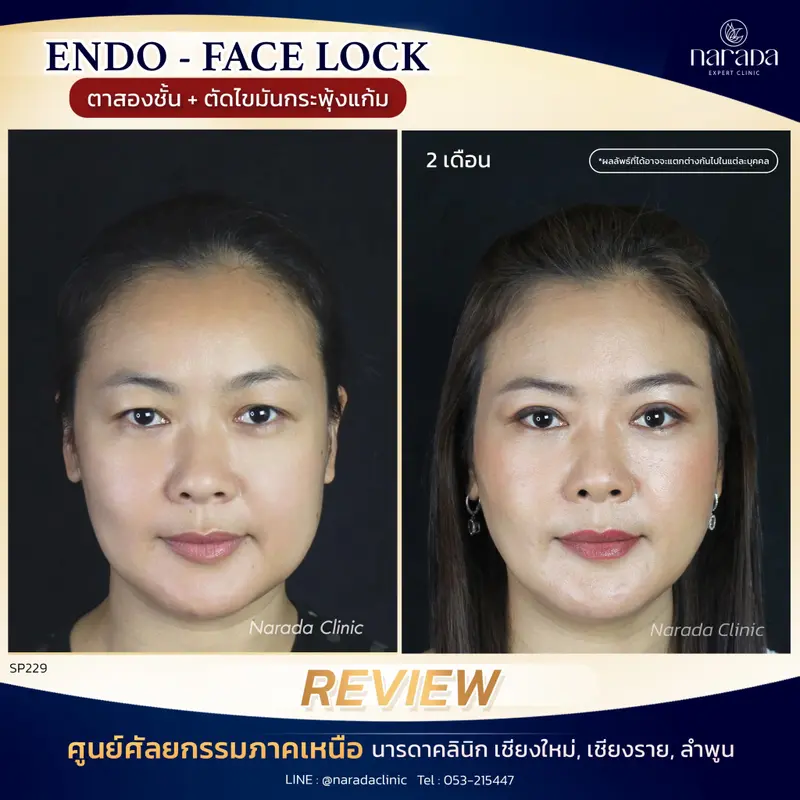 ปรับรูปหน้าให้ดูดี อ่อนเยาว์กว่าวัย  แพทย์ผู้เชี่ยวชาญนารดาคลินิก 