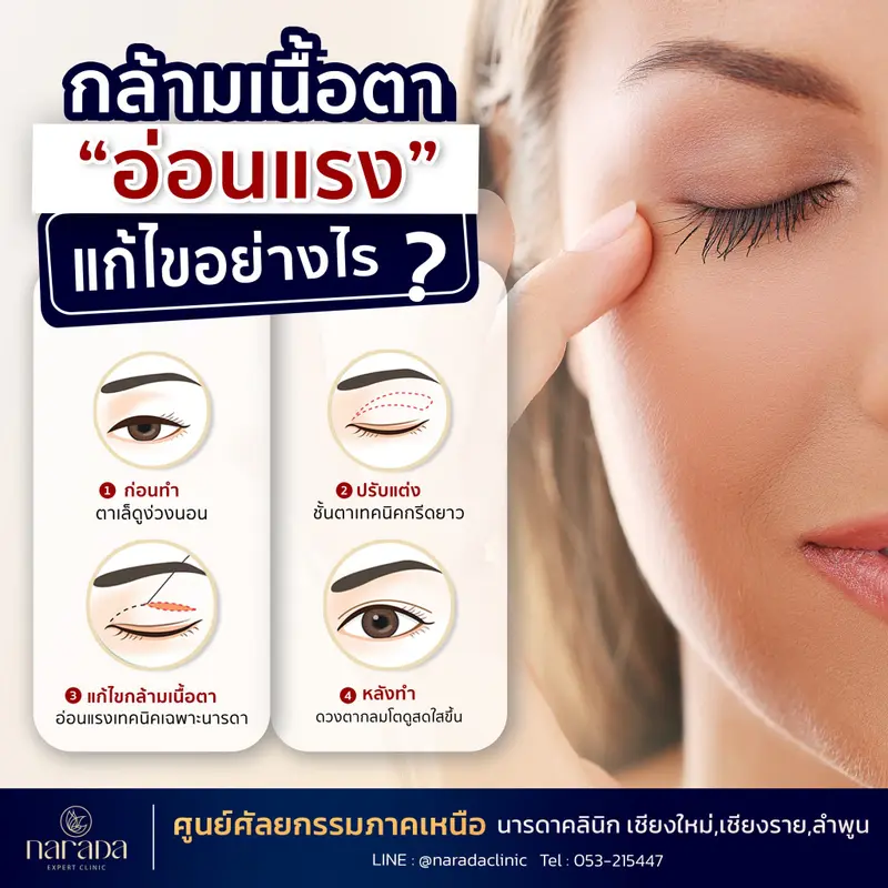 การแก้ไขกล้ามเนื้อตาอ่อนแรง เทคนิคเฉพาะแพทย์ ที่ นารดาคลินิก