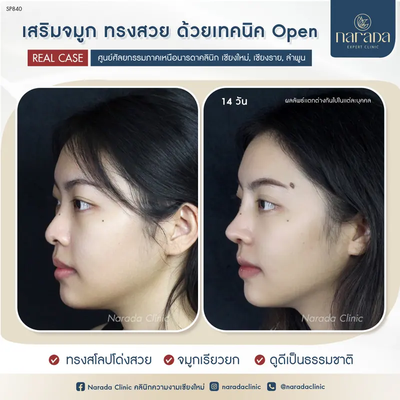 เสริมจมูก ทรงสวย ด้วยเทคนิค Open