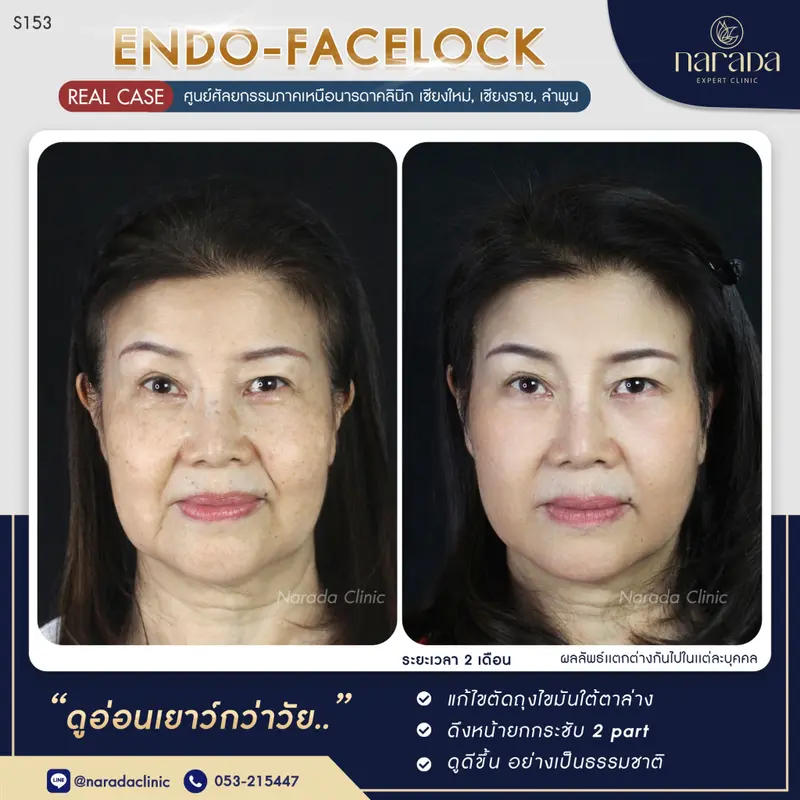 ลดอายุด้วยใบหน้าที่เด็กลง ที่ นารดาคลินิก