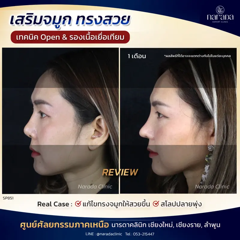 จมูกพุ่ง ทรงสวย ที่ นารดาคลินิก