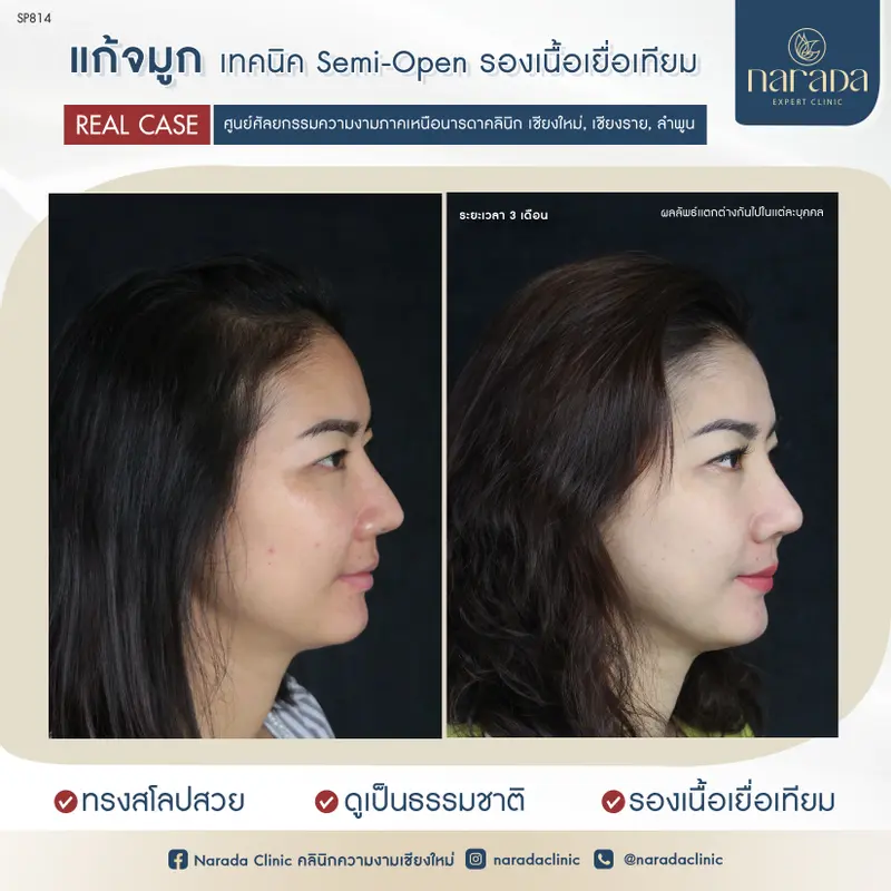 ปรับทรงแก้จมูกใหม่ ให้ดูสโลป ปลายจมูกให้ยาวรับกับรูปหน้า