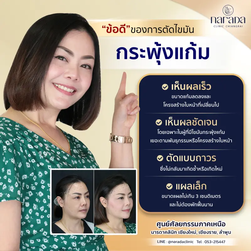 การตัดไขมันกระพุ้งแก้ม มีข้อดีอย่างไร ?