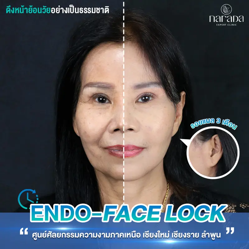 ดึงหน้าย้อนวัย เทียบข้างต่อข้าง @ นารดาคลินิก