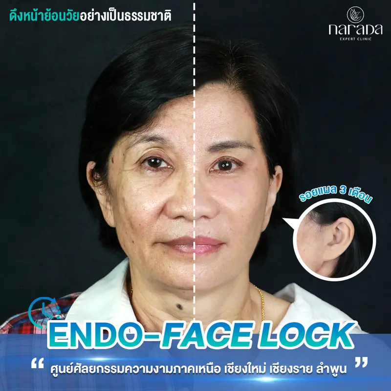 ย้อนวัยให้ผิวหน้า @นารดาคลินิก