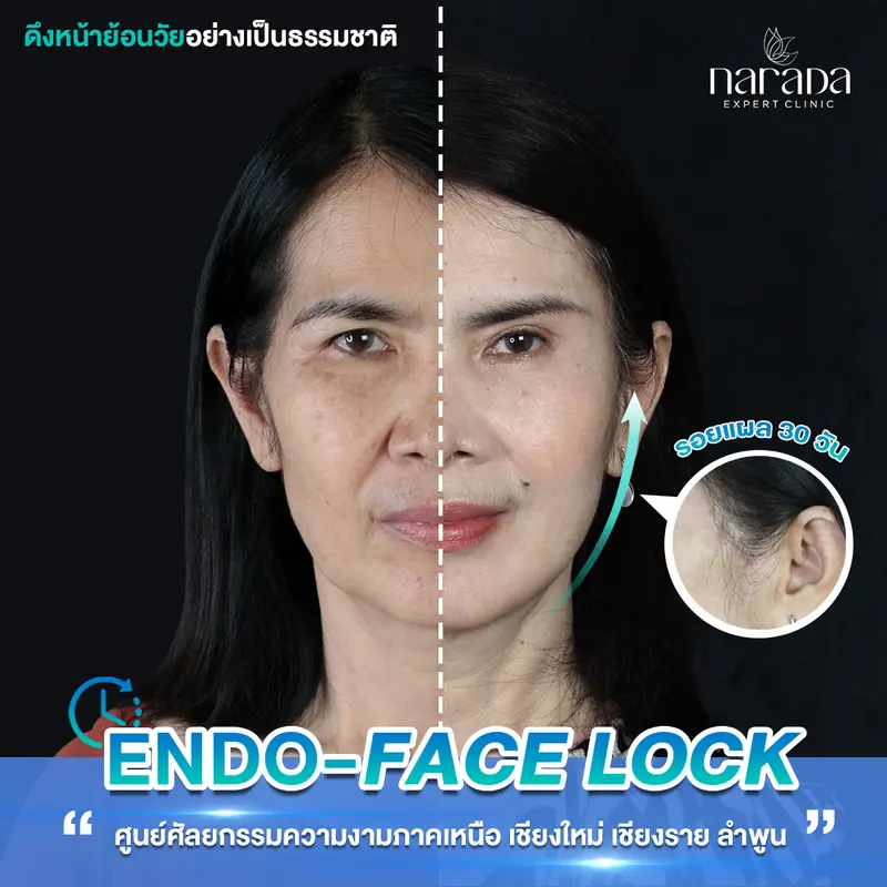 ยกกระชับผิว โดยผู้เชี่ยวชาญเฉพาะด้าน @นารดาคลินิก