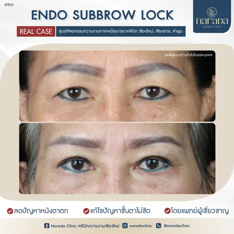 Endo Subbrow Lock ยกกระชับหนังตา เก็บหนังตาส่วนเกิน แบบไร้แผลเป็น @นารดาคลินิก
