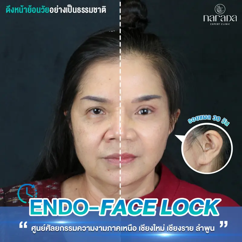 ชั้นตาเห็นชัดขึ้น และใบหน้าตึงกระชับ ที่ นารดาคลินิก