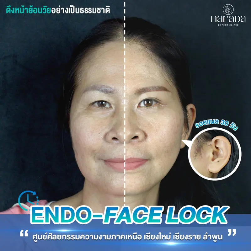 ยกกระชับรูปหน้า เปิดชั้นตา ที่ นารดาคลินิก