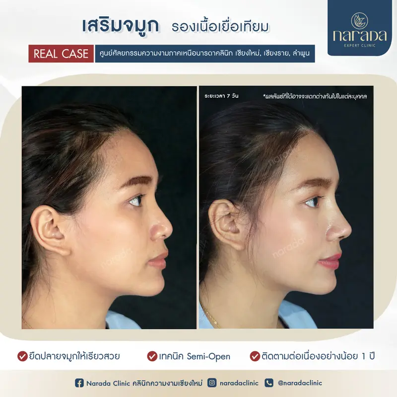 🌈✨ยืดปลายจมูก ปรับทรงจมูกสโลปสวย ที่ นารดาคลินิก🌈✨