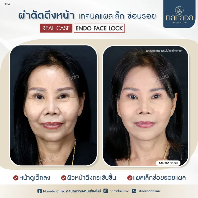 😀😀เก็บส่วนแก้มที่ห้อย ให้กระชับ ที่ นารดาคลินิก😀😀
