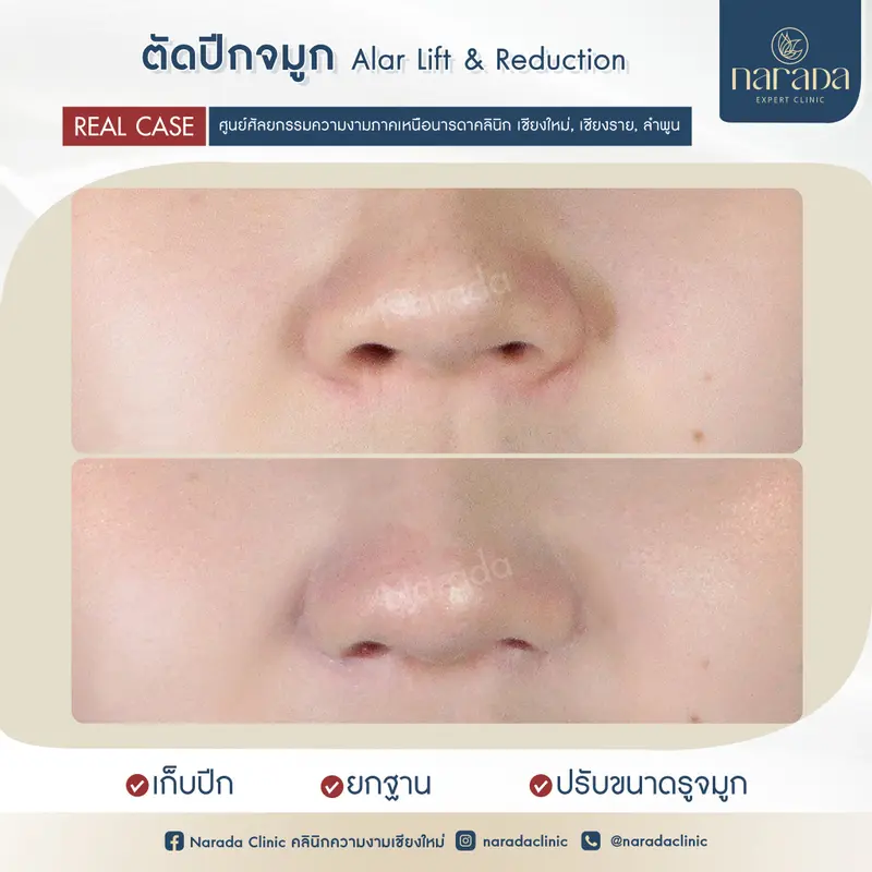 💫💫ตัดแต่งปีกจมูก ที่ นารดาคลินิก💫💫