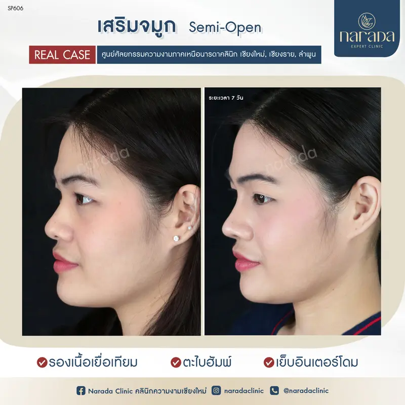 🌈🌈เสริมจมูกให้เข้ากับใบหน้า ที่ นารดาคลินิก🌈🌈