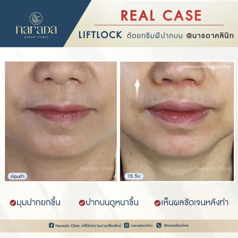 👄👄ตัดยกริมฝีปากบน ที่ นารดาคลินิก👄👄