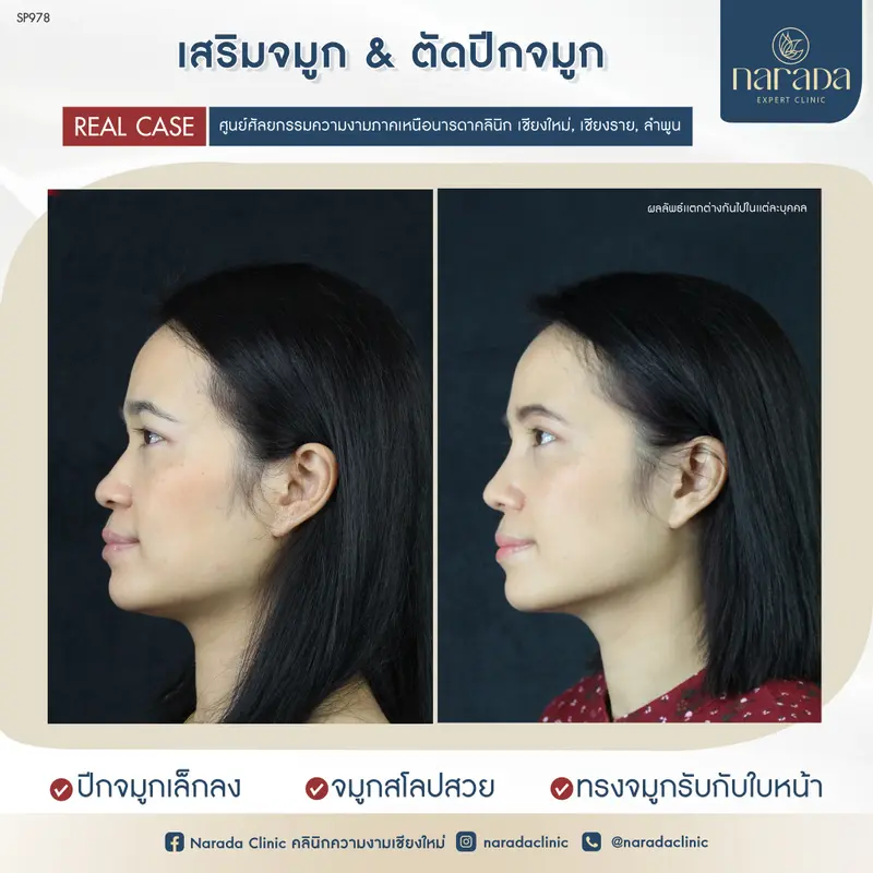 🌟🌟เพิ่มสันจมูกให้สูงขึ้น รับกับใบหน้า ที่ นารดาคลินิก🌟🌟