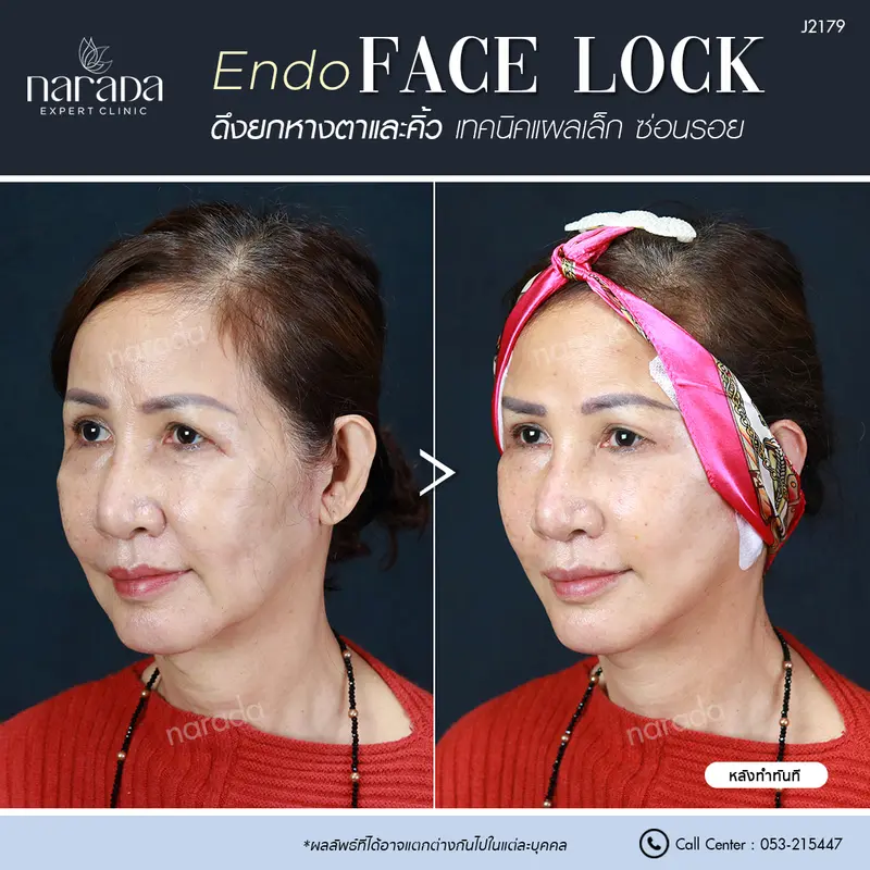 🧚‍♀️บอกลาหางตาตก คิ้วตก ดูไม่สดใส 🧚‍♀️
