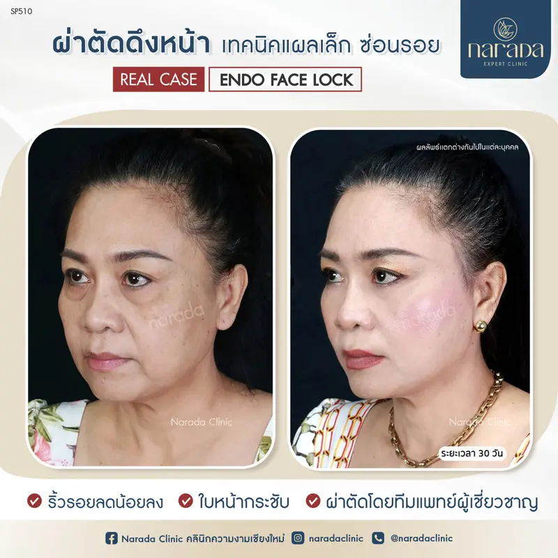 🌸🌸ผิวหน้ากระชับ อ่อนเยาว์ ที่ นารดาคลินิก🌸🌸
