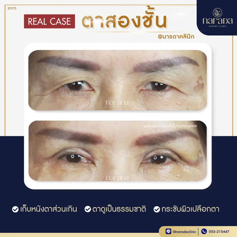 👋🏻👋🏻บอกลาปัญหา ชั้นตามีหลายชั้น ชั้นตาไม่เท่ากัน ทำให้ดูไม่สดใส👋🏻👋🏻