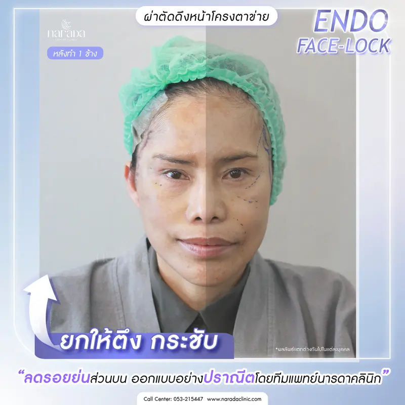 ยกอย่างตึงกระชับ.. " 4 ระดับชั้นผิว"✨