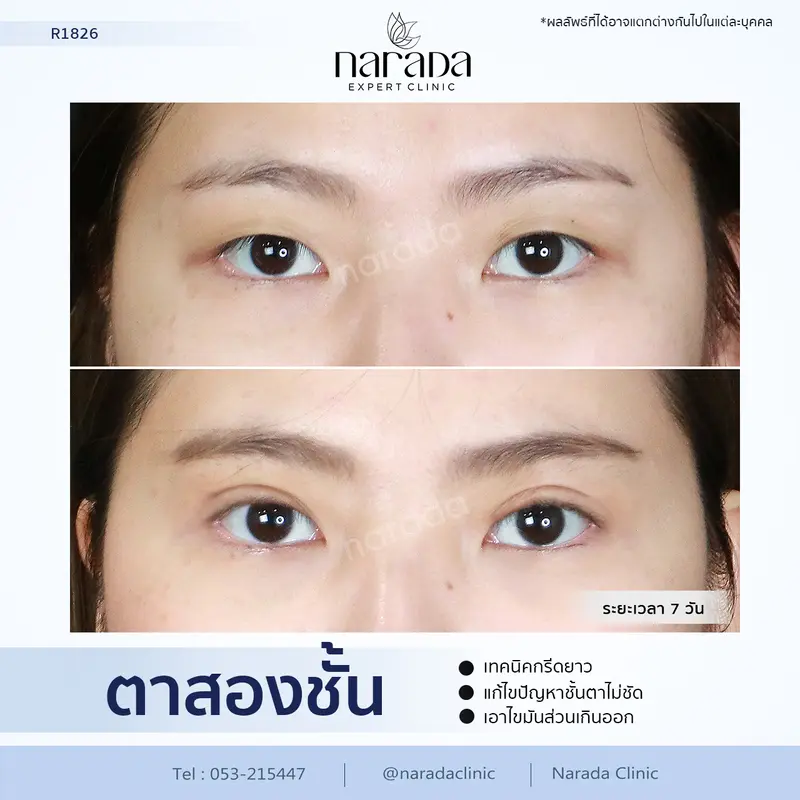 🌷ตาสวยคมชัด สดใสขึ้น🌷