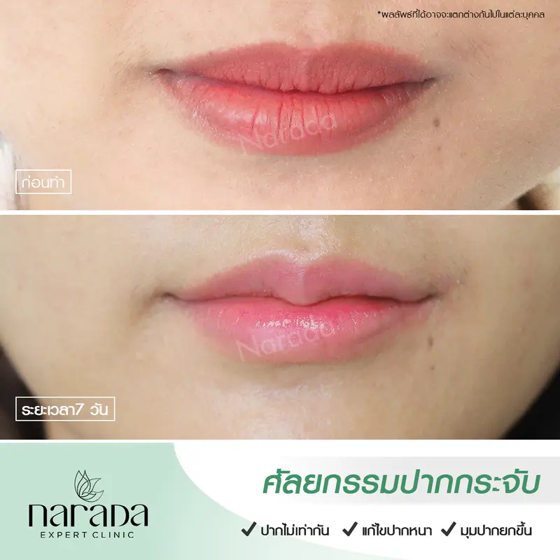 💓ปัญหาปากบนหนา ปากไม่เท่ากัน 💓