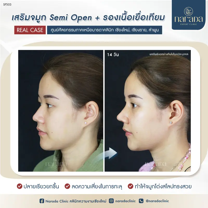 เสริมจมูกปลายเชิด ด้วยเทคนิค Semi Open