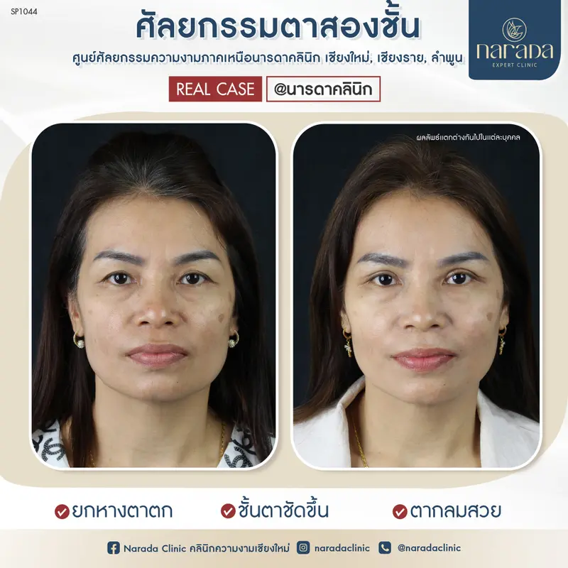 💐เพิ่มชั้นตา ให้เด่นชัดขึ้น ที่ นารดาคลินิก💐