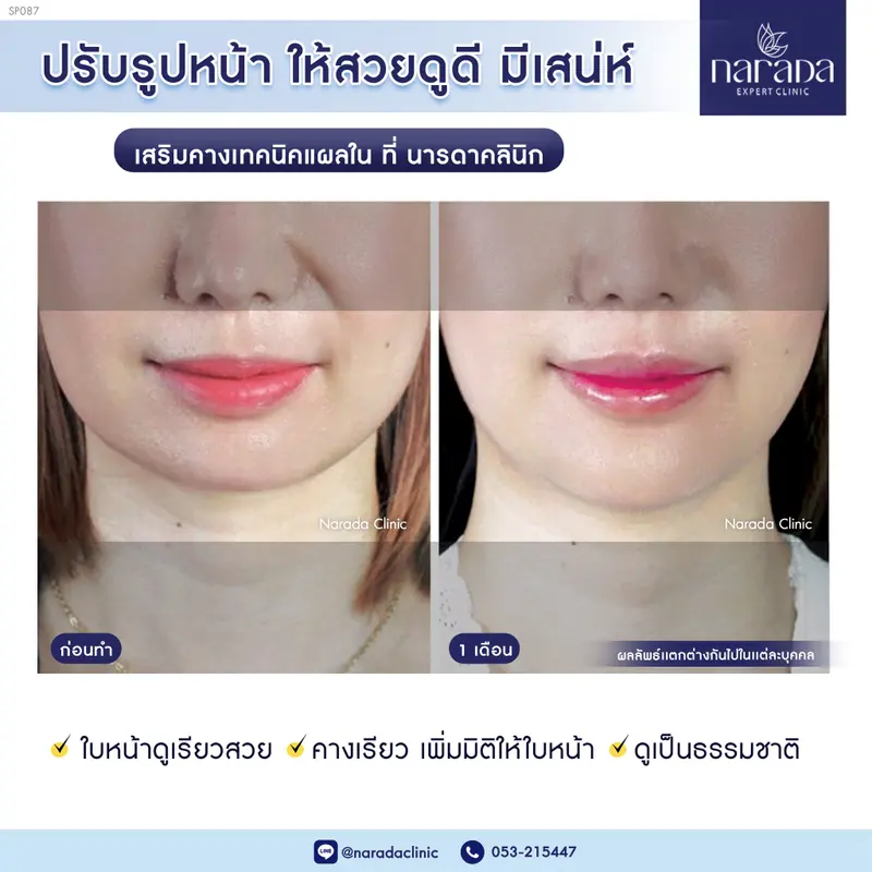 😍😍เพิ่มมิติให้รูปหน้า ด้วยการเสริมคาง😍😍